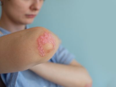 Do I Have Psoriasis