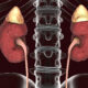 Kidney Disease