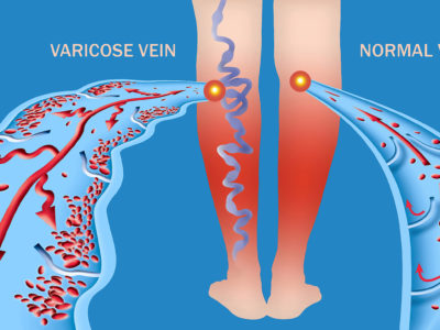 Varicose Veins vs. Spider Veins: What You Need To Know