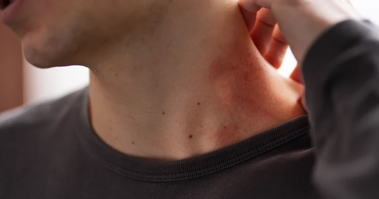 Heat rash on neck showing skin irritation.