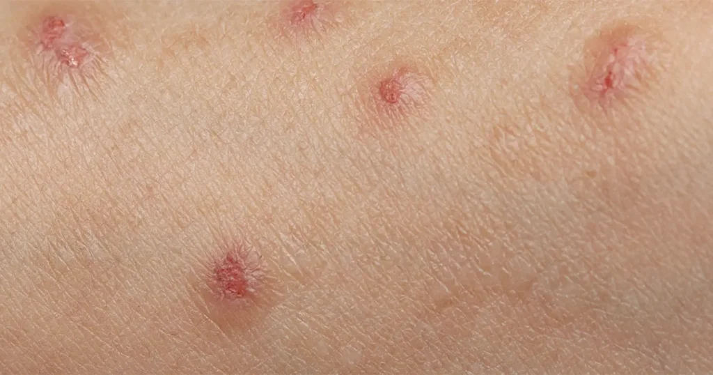 Lesion appearance on human skin.