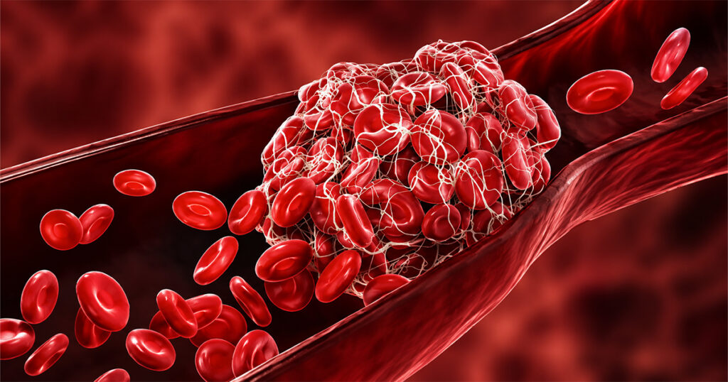 Blood clot blocking a blood vessel
